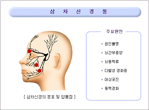 삼차신경통 증상 및 원인, 치료 6